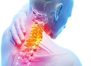 Pain and shelter in the cervix area with the third level of osteoarthritis