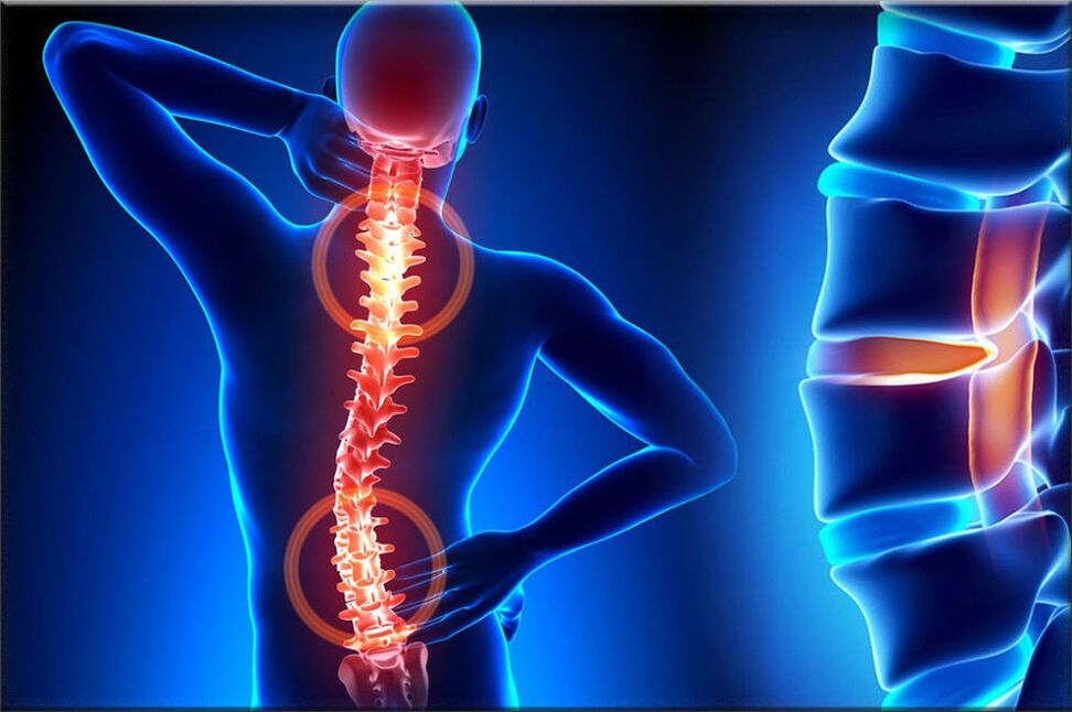 Osteomyelitis of the spine
