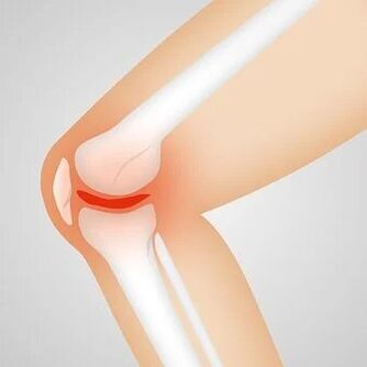Arthropathy is a non-inflammatory joint disease