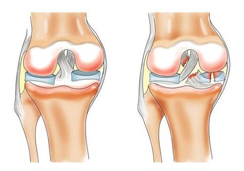 healthy knee joints and knee arthritis